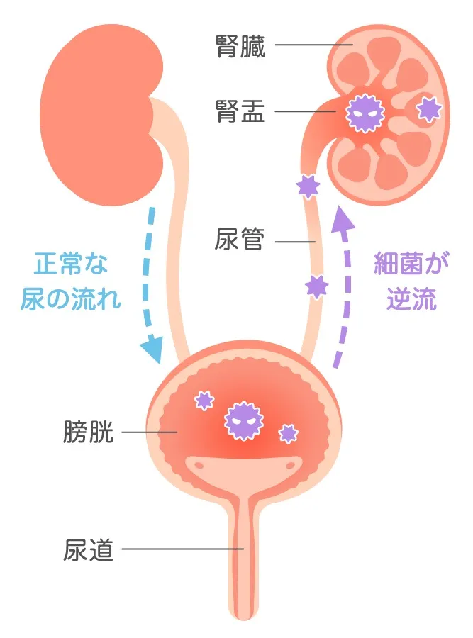 排尿がしみるのは膀胱炎かも？大人の排尿トラブルを訪問看護の視点で