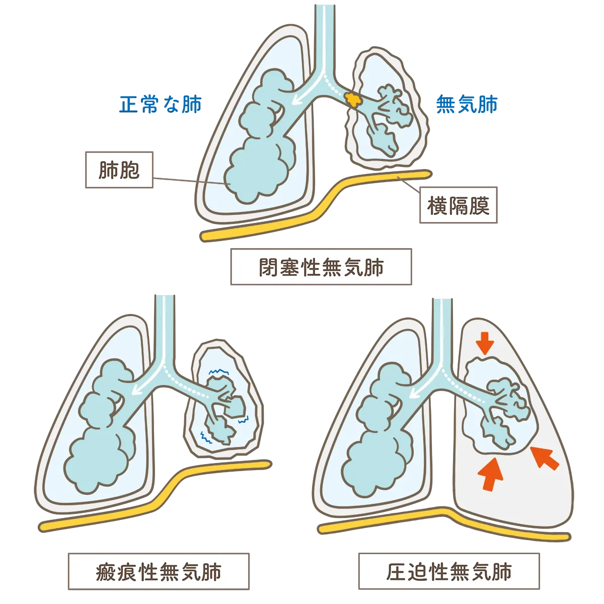 無気肺は症状がなくても進行する？ “静かな肺の異変”を防ぐために
